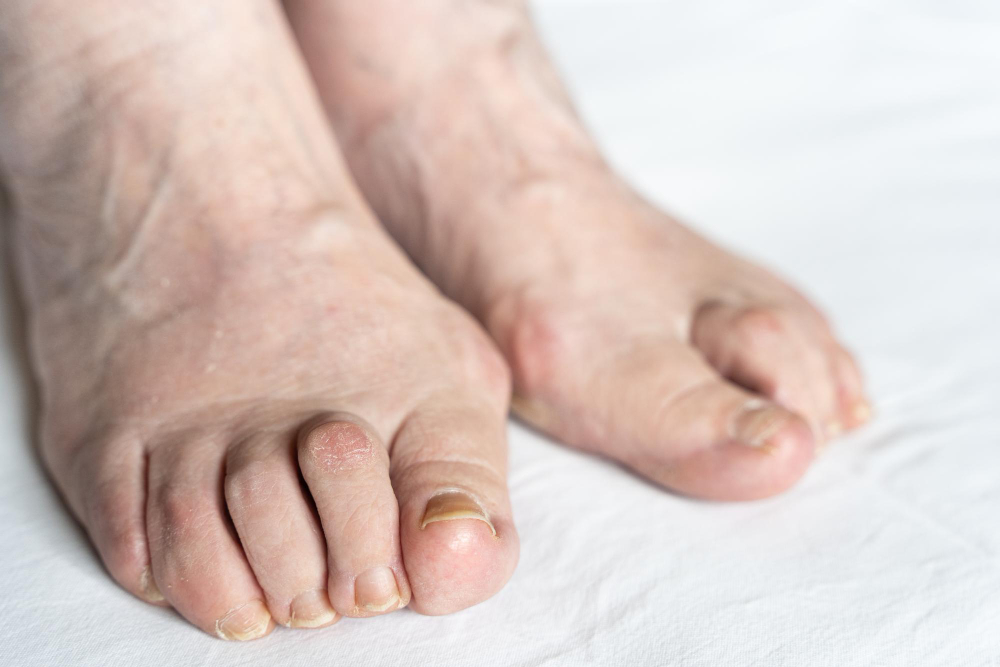 Bunion Treatment Center Boynton Beach, FL