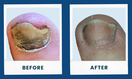 toefx before and after in the Palm Beach County, FL: Boynton Beach, West Palm Beach, Delray Beach & Boca Raton, Lantana & Lake Worth Beach, Ocean Ridge & Gulf Stream, Hypoluxo, Wellington, Greenacres, FL & Broward County, FL: Plantation, Davie, Cooper City, Lauderhill & Lauderdale Lakes, Weston, Pembroke Pines & Miramar, FL areas