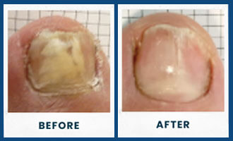 toefx before and after in the Palm Beach County, FL: Boynton Beach, West Palm Beach, Delray Beach & Boca Raton, Lantana & Lake Worth Beach, Ocean Ridge & Gulf Stream, Hypoluxo, Wellington, Greenacres, FL & Broward County, FL: Plantation, Davie, Cooper City, Lauderhill & Lauderdale Lakes, Weston, Pembroke Pines & Miramar, FL areas