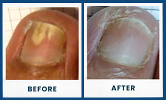 toefx before and after in the Palm Beach County, FL: Boynton Beach, West Palm Beach, Delray Beach & Boca Raton, Lantana & Lake Worth Beach, Ocean Ridge & Gulf Stream, Hypoluxo, Wellington, Greenacres, FL & Broward County, FL: Plantation, Davie, Cooper City, Lauderhill & Lauderdale Lakes, Weston, Pembroke Pines & Miramar, FL areas